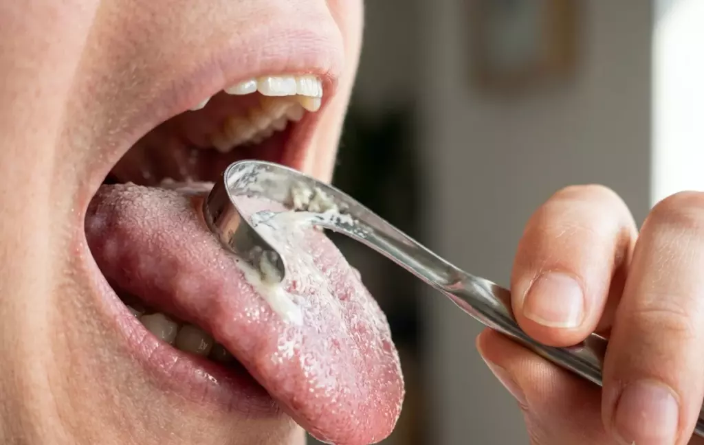 Складчатый язык: как убрать налёт и запах — советы стоматолога - фото Гермес Дент