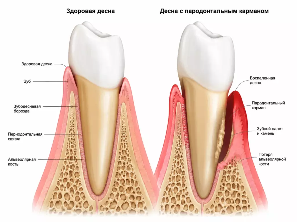 Зубодесневые карманы: что это, чем опасны и как их чистят - фото Гермес Дент